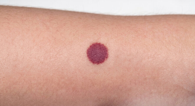 Purpuric Macule - Macule in Human Skin &mdash; Medical Dermatology Plate (24-100)