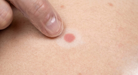 Fototapeta premium Typhoid Rose Spots in human skin - Macule in Human Skin — Medical Dermatology Plate (26-100)