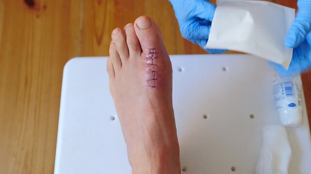 Surgical stitches on toe after bone spur removal surgery. Medical worker in gloves applying sterile gauze over postoperative sutures on male foot