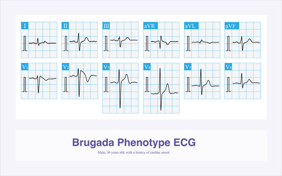 A 36 year old man survived CPR after sudden syncope. The electrocardiogram was suggestive of Brugada syndrome type 1. Finally, he was treated with an ICD.
