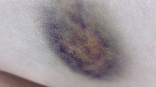 Detailed macro shot of a painful hematoma with purple and yellow bruise on human skin caused by physical trauma accident or domestic violence injury medical healthcare science concept background