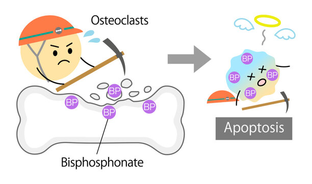 Apoptosis of Osteoblasts induced by Bisphosphonates