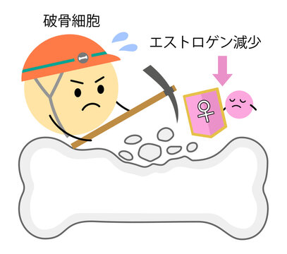 閉経で女性ホルモンのエストロゲンが低下し破骨細胞による骨吸収が活性化されたイラスト