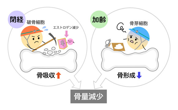閉経と加齢で骨量が減少しているイラスト横