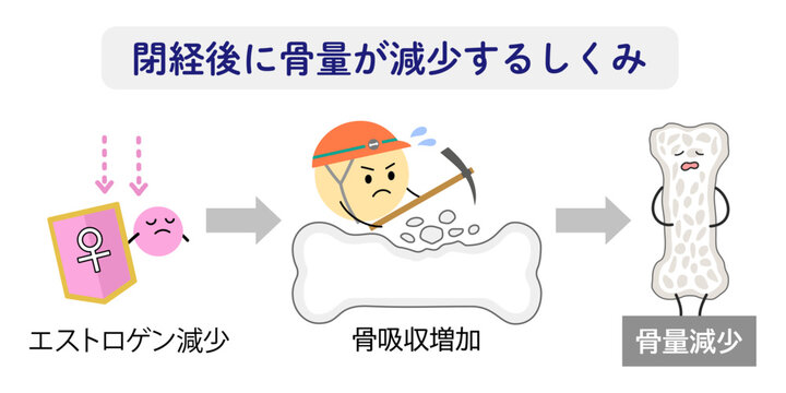 閉経後に骨量が減るしくみをあらわすイラスト