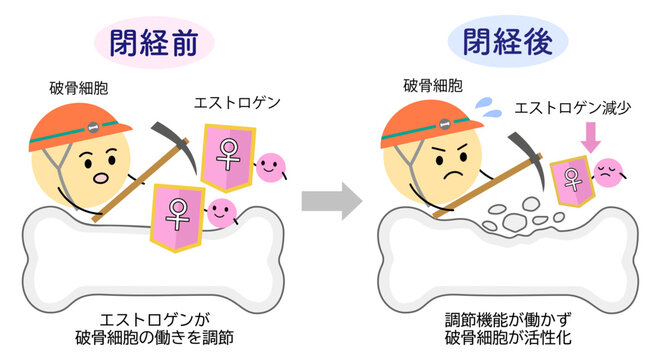 女性ホルモンのエストロゲンと破骨細胞の働き、閉経前後の比較イラスト