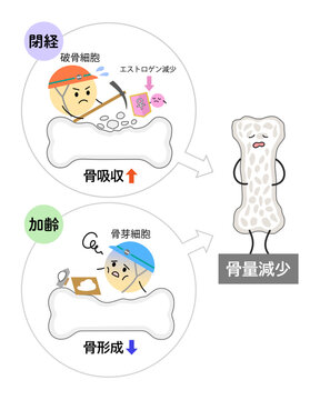 閉経と加齢で骨量が減少しているイラスト縦