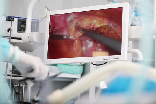 Laparoscopic instruments in hands of surgeon. Minimally invasive surgery. Surgical intervention through small punctures in abdominal cavity. Team of surgeons. Modern abdominal surgery