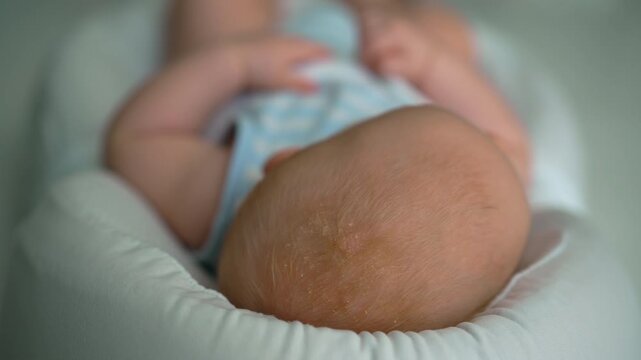 Close-up of cradle cap crusts on baby scalp.