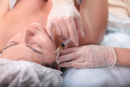 Facial plasmolifting procedure. Injections of your own plasma in beauty salon. Patient's biomaterial. Concept of cosmetology. Patient's face in close-up
