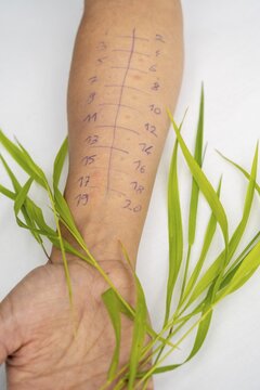 Allergy test, prick test, skin test, different ingredients are tested for allergic reactions, arm with markings and blades of grass, Germany