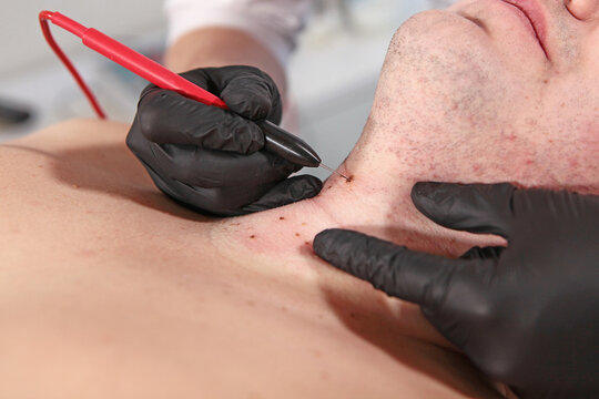 Man undergoing procedure to remove warts and papillomas. Laser removal of papillomas on skin. Aesthetic medicine. Laser cauterization of benign growths on skin. Prevention of melanoma.