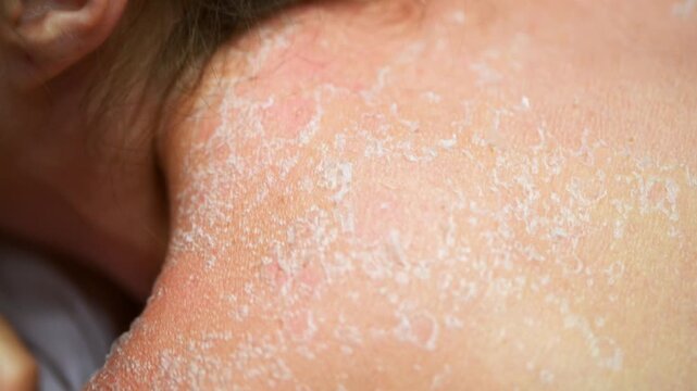 Close up desquamation skin peeling after sunburn on upper back with dry flakes in natural light