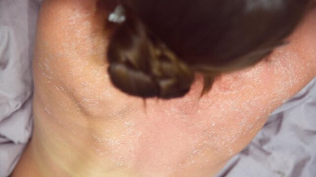 Dry peeling skin on upper back showing skin desquamation after sunburn in soft indoor lighting