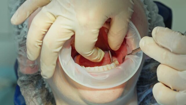 A close-up of a dental surgeon checking the position of a parallel pin in the jawbone to ensure correct alignment before dental implant placement
