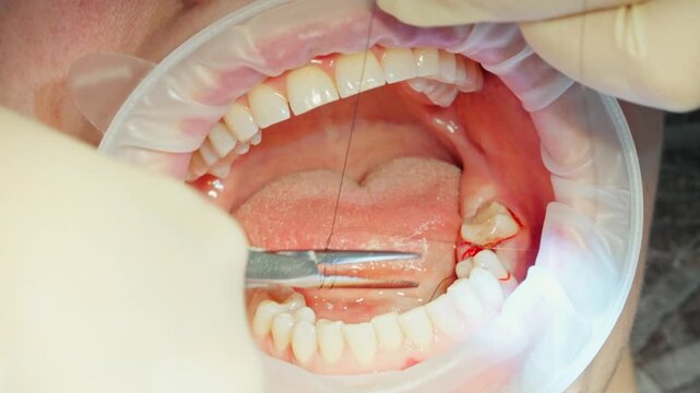 Close up a qualified dental surgeon stitches the gum with sterile threads after installing a dental implant bode, which is screwed into the bone jaw