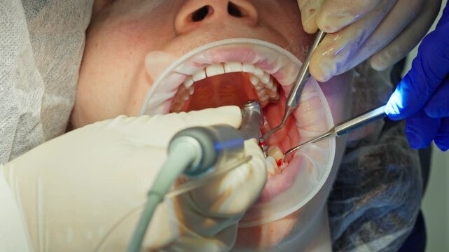  A close-up of dentists drilling a hole for a dental implant in the jaw of a young adult female patient with a dental drill, while draining excess saliva. Footage of a real-life surgical procedure