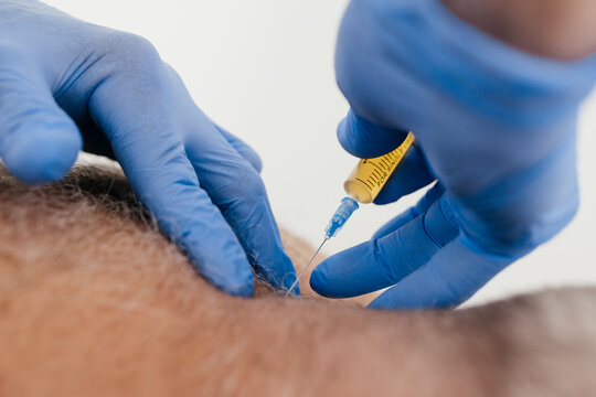 Close-up of a physician performing a platelet-rich plasma PRP injection into a patient's neck. Regenerative medicine procedure for hair restoration using autologous plasma therapy