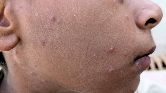 Close-Up of Human Face Cheek Skin Showing Acne Pimples and Red Spots for Dermatology Medical Reference