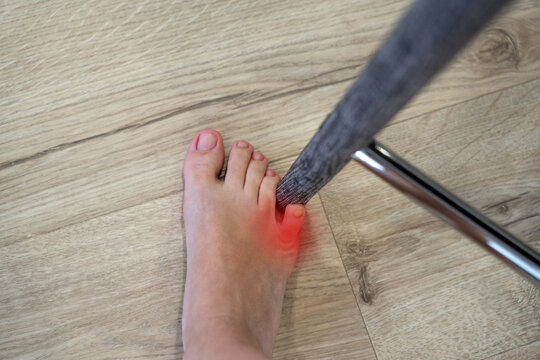 Woman hit chair with the little toe. Incident at home. Red spot showing injury of foot little finger