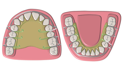 Maxillary and mandibular Hawley retainer orthodontic appliance © Bhuvana