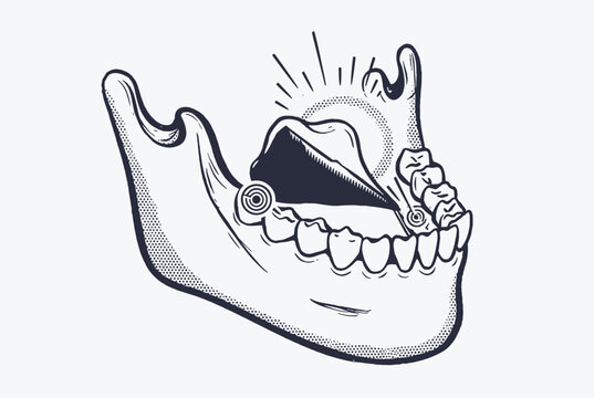 Detailed line art illustration of a human mandible jaw bone with a missing tooth and light rays for dental health or surgery concepts.
