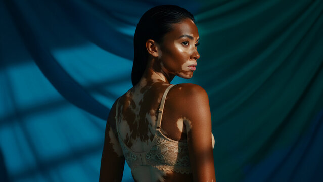 Woman with vitiligo posing in lingerie against blue fabric. She displays skin pigmentation and natural beauty in a studio. Inclusive diversity theme, ideal for fashion and body positivity.