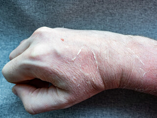 Fototapeta premium Sunburned Hand with Dry Peeling Skin and Small Lesion