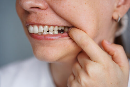 Close up shot of a woman pointing her finger to a gap in her teeth where a tooth is missing, highlighting oral health issues, dental consultation, tooth extraction or implant need concept