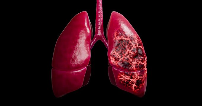 Human lung damage by a cigarette embedded into diseased lungs, showing how smoking leads to cancer, emphysema, COPD, respiratory failure, and life-shortening conditions linked tobacco. 3d rendering 
