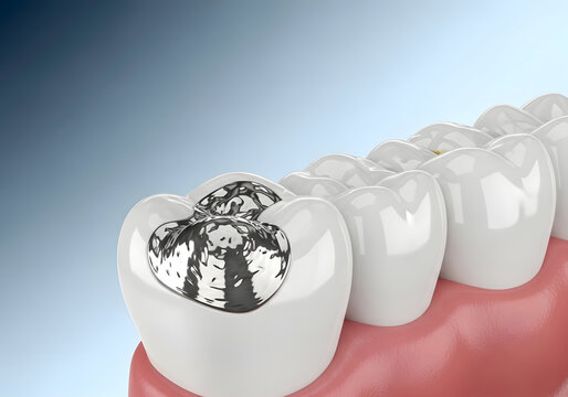 Close up of human teeth with silver amalgam fillings showing dental restoration and metal dental material work