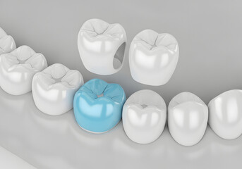 Fototapeta premium Dental crown procedure showing a single blue tooth replacement in a row of white teeth for restorative dentistry