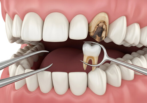 Dental extraction procedure of a decayed tooth using surgical tools in a clinical setting