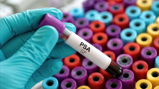 Gloved hand holding PSA blood test tube for prostate cancer screening in clinical laboratory.
