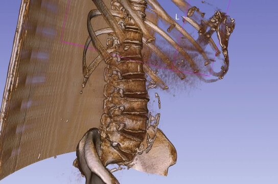 3D Volume Rendering of Native CT Scan of the Abdomen and Pelvis, High-Resolution 1.2 mm Multislice Computed Tomography Medical Visualization
