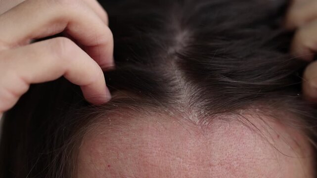Woman scratching scalp because of dermatitis and dandruff. 4K, slow motion.