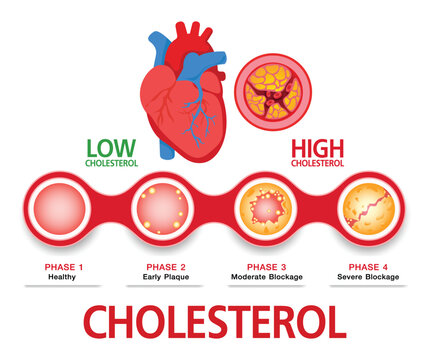 Cholesterol in artery, health risk , vector design
