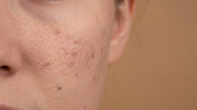 Macro close up of post-acne hyperpigmentation and scarring on cheek, dark spot skincare concern, dermatology dark mark treatment with tan copy space