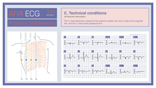 Posterior wall leads are three chest leads&mdash;comprising leads V7, V8, and V9&mdash;placed on the left side of the back to detect myocardial ischemia of the posterior wall.
