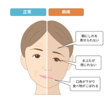 顔面神経麻痺による顔の左右非対称と症状の比較イラスト