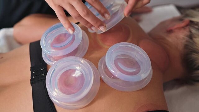 A practitioner performs cupping therapy on a person's back using suction cups to create a vacuum effect. This treatment aims to promote health and recovery through traditional methods