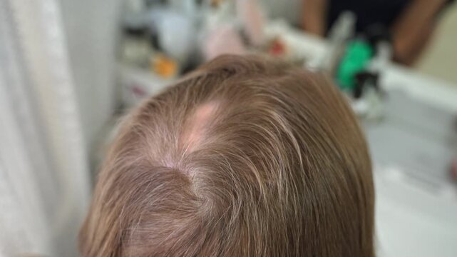 An intimate close-up captures the top of a woman's head, revealing light brown hair and a distinct patch of scalp due to alopecia, documenting her personal hair journey.