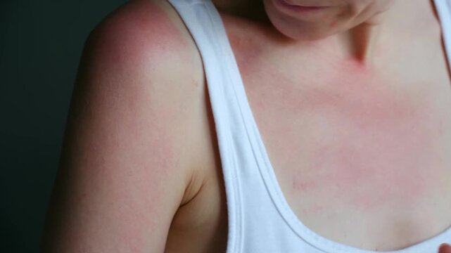 Uncomfortable woman touching her red, painful skin on the chest and shoulder, showing symptoms of sunburn, sun allergy, or dermatitis after excessive sun exposure and ultraviolet radiation