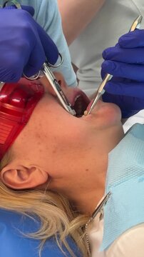woman in dentistry tooth filling injection anesthesia. modern dental treatment with local anesthesia rubber dam filling procedure suction and bite check during professional tooth restoration