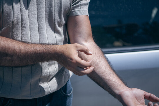 A person's hands itch. Close-up.