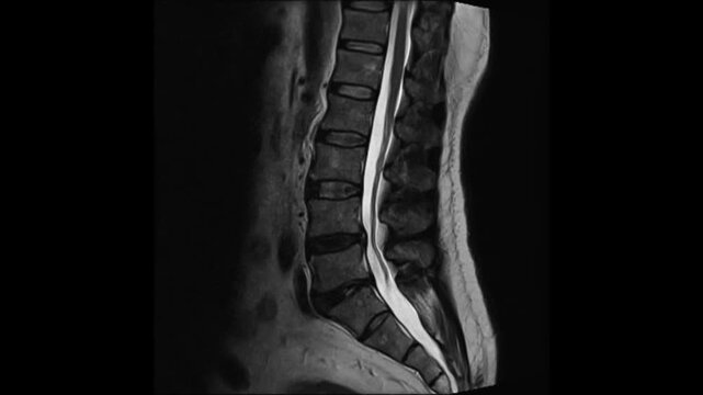 MRI Scan of Lumbar Spine Health Analysis