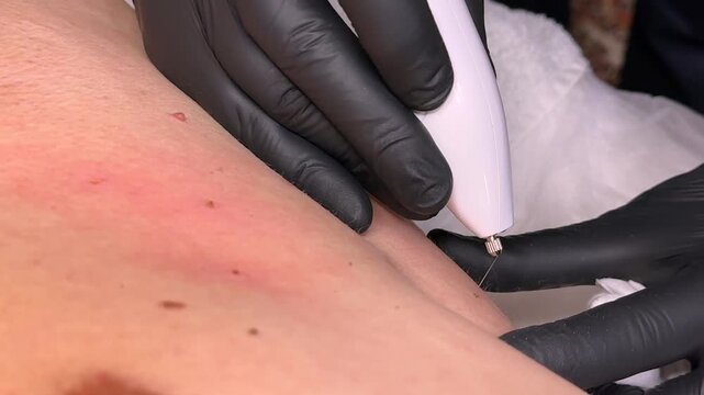 Macro view of cosmetic skin lesion removal using electrocautery. Professional aesthetic dermatology treatment, healthy skin, beauty, precision, modern medical care.