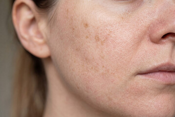 Naklejka premium This close up shows a person's facial skin with mild sun spots and uneven pigmentation. The image captures the texture and tone of the skin under natural light