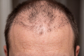 Naklejka premium Macro close-up shows a frontal hairline with visible thinning. The texture and condition of the hair are clear. The focus is on hair loss and its appearance