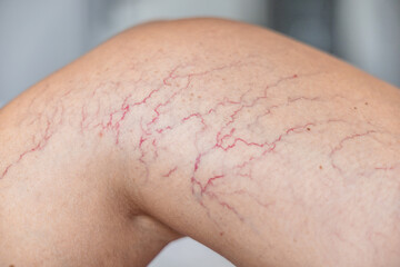 Fototapeta premium Close-up of a tanned leg showing visible varicose veins and capillaries. The skin appears smooth with a few dark lines indicating vascular issues.